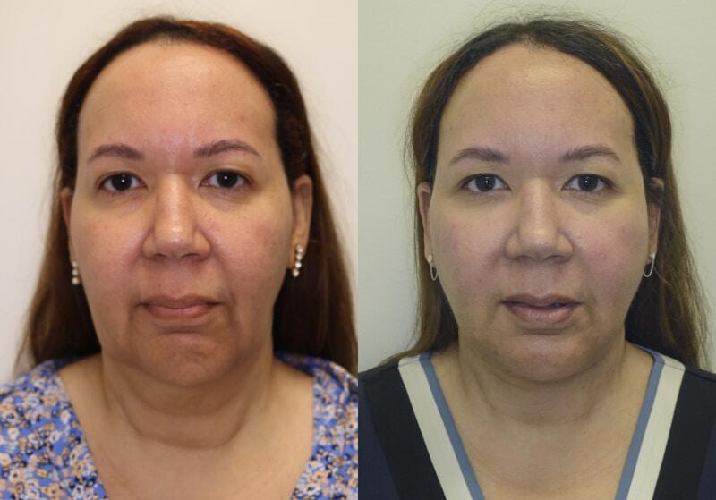 Facelift before and after - before