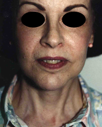Face Lift and Neck Lift before and after - after