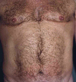 Liposuction before and after - after