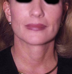 Face Lift and Neck Lift before and after - after