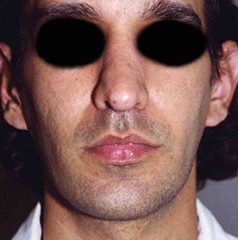 Rhinoplasty before and after - after