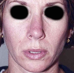 Rhinoplasty before and after - after