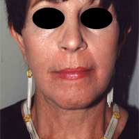 Face Lift and Neck Lift before and after - after