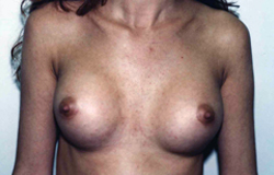Breast Augmentation before and after - after