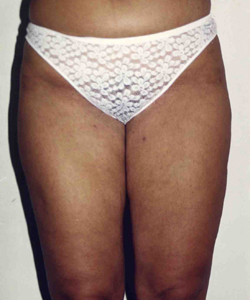 Liposuction before and after - after