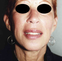 Face Lift and Neck Lift before and after - after