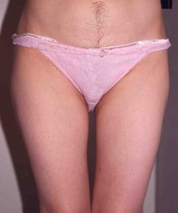 Liposuction before and after - after