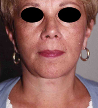 Face Lift and Neck Lift before and after - after