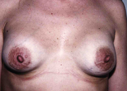 Breast Augmentation before and after - after