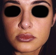 Rhinoplasty before and after - after