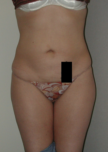 Liposuction before and after - after