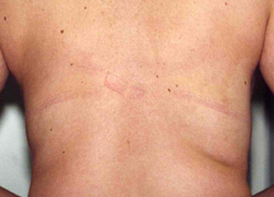 Liposuction before and after - after