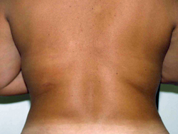 Liposuction before and after - after