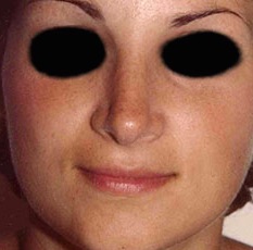 Rhinoplasty before and after - after