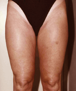 Liposuction before and after - after