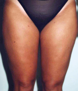 Liposuction before and after - after