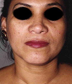 Rhinoplasty before and after - after