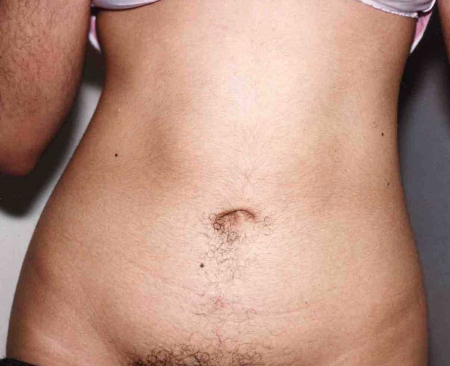 Liposuction before and after - after