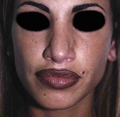 Rhinoplasty before and after - after