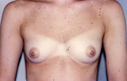 Breast Augmentation before and after - before