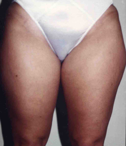 Liposuction before and after - before