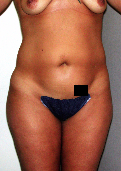 Liposuction before and after - before