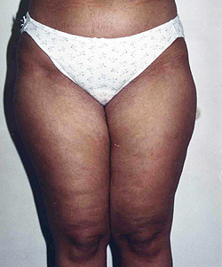 Liposuction before and after - before