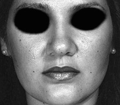 Rhinoplasty before and after - before