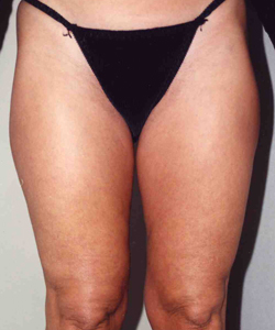 Liposuction before and after - before