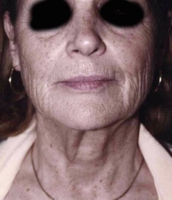 Face Lift and Neck Lift before and after - before