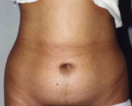Liposuction before and after - before