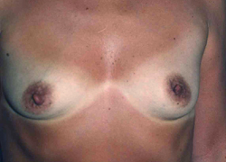 Breast Augmentation before and after - before