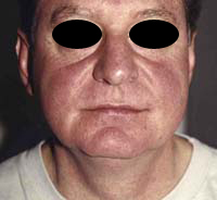 Face Lift and Neck Lift before and after - before