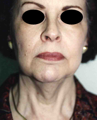 Face Lift and Neck Lift before and after - before