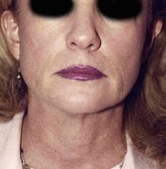 Face Lift and Neck Lift before and after - before