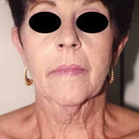 Face Lift and Neck Lift before and after - before