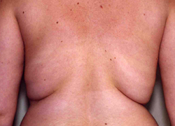 Liposuction before and after - before