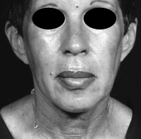 Face Lift and Neck Lift before and after - before