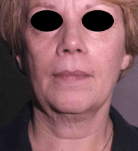 Face Lift and Neck Lift before and after - before