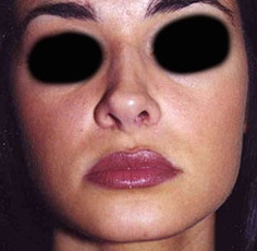 Rhinoplasty before and after - before