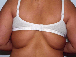 Liposuction before and after - before