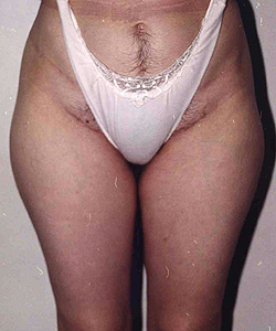Liposuction before and after - before
