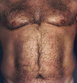 Liposuction before and after - before