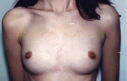 Breast Augmentation before and after - before