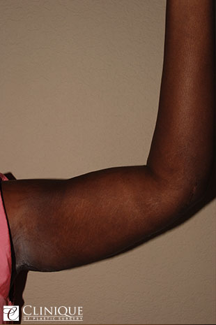 Liposuction before and after - after