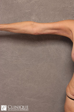Liposuction before and after - after