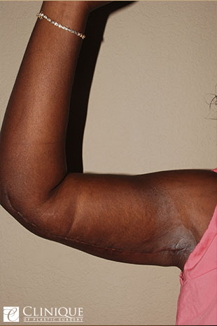 Liposuction before and after - after
