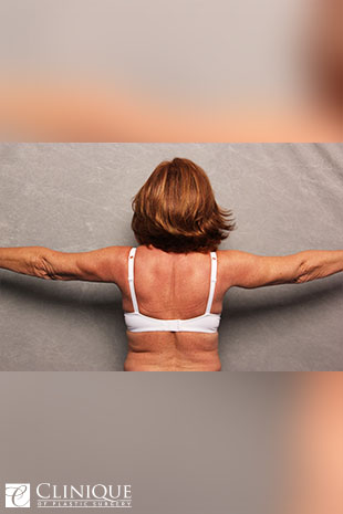 Liposuction before and after - after