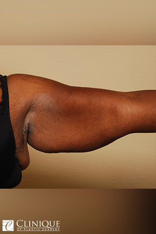 Liposuction before and after - before