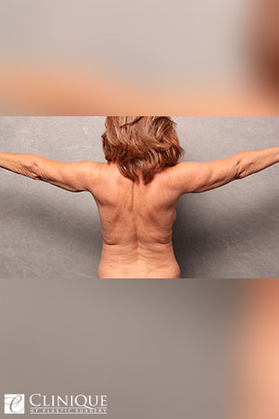 Liposuction before and after - before